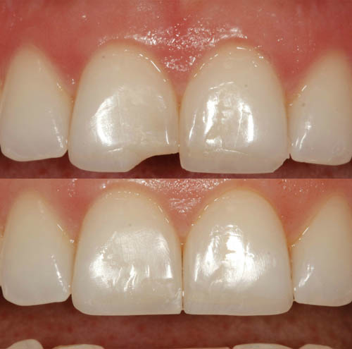 Composite bonding before and after 2